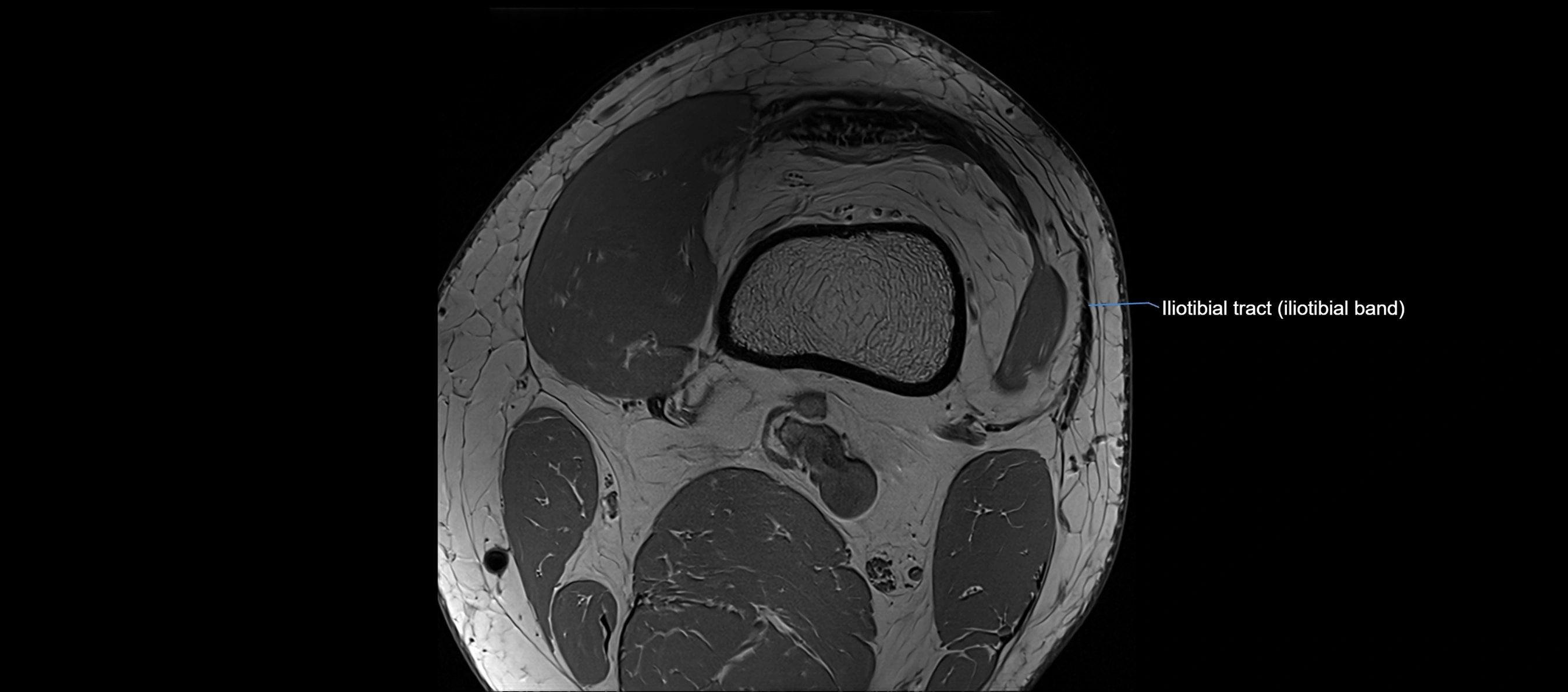 MRI Knee axial  ligaments cross sectional anatomy 3T  radiology  image-img-03001-00003.webp